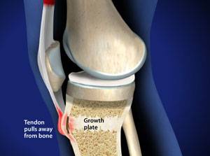 What is Osgood-Schlatter Disease?