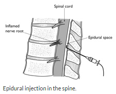 TREATING LOW BACK PAIN WITH LUMBAR STEROID EPIDURAL INJECTIONS