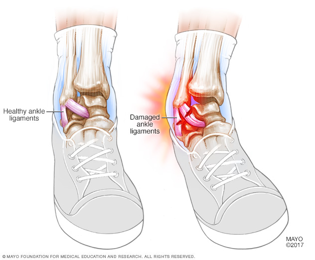 ankle internal rotation