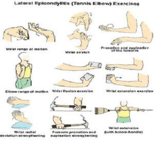 tennis elbow exercises | Michigan Sports and Spine Center